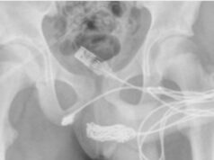 Un chico intentaba medir su pene y se le enredó un cable USB en la uretra: tuvieron que operarlo