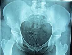 Jujuy: un preso que ocultaba un paquete en su recto terminó hospitalizado