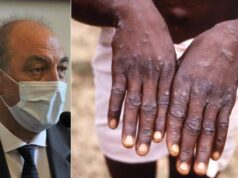 Buljubasich sobre la viruela del mono: “Es muy poco probable que escale como lo hizo el Covid”