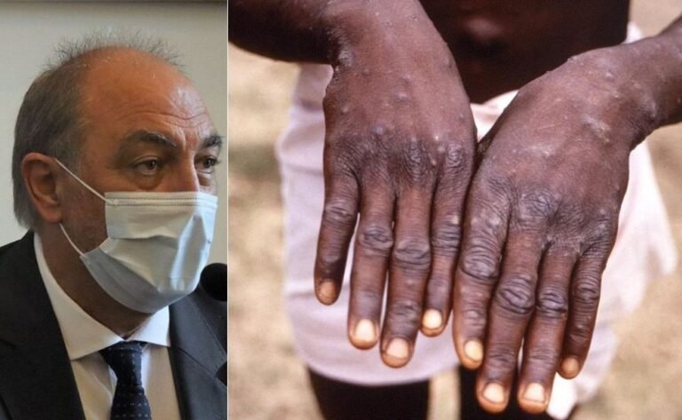 Buljubasich sobre la viruela del mono: “Es muy poco probable que escale como lo hizo el Covid”
